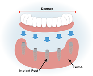 dentures graphic