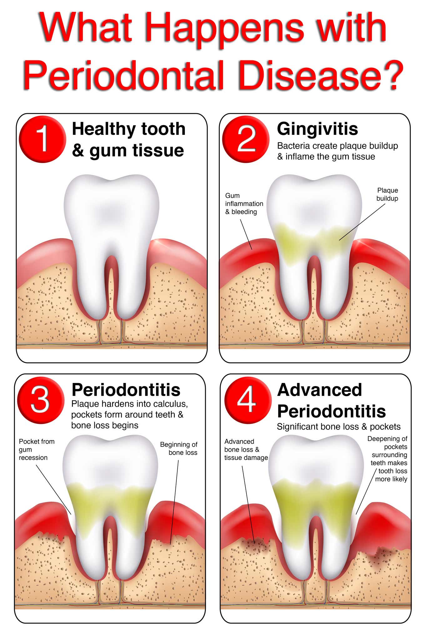 What Is Periodontal Disease? - Waterloo Heights Dental