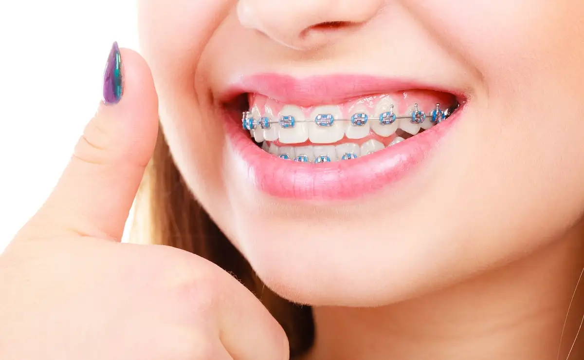 BRACES TREATMENT - COMPLETE DENTAL SOLUTIONS